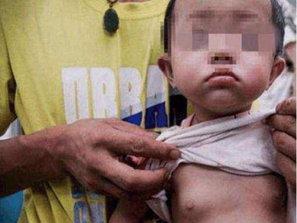 Bé gái 5 tuổi ngực nổi cục, dậy thì sớm vì bố mẹ thường xuyên cho ăn món mà người Việt nghĩ là bổ dưỡng - Ảnh 5. Bé gái 5 tuổi ngực nổi cục, dậy thì sớm vì bố mẹ thường xuyên cho ăn món mà người Việt nghĩ là bổ dưỡng - Ảnh 5.