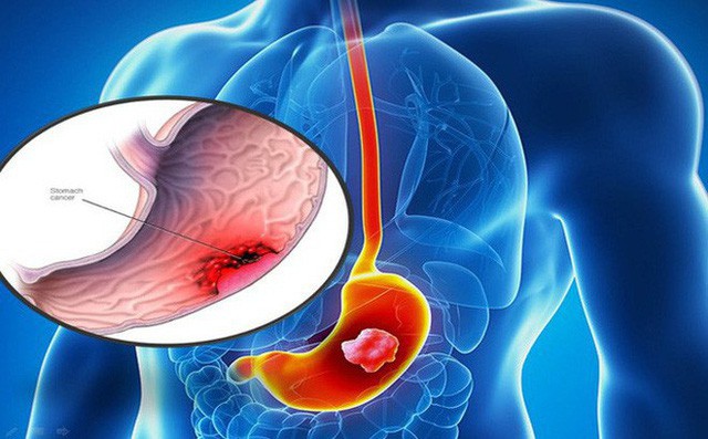 Nếu ai vẫn giữ thói quen uống trà này, hãy đề phòng nguy cơ mắc bệnh ung thư tăng hơn 40% - Ảnh 2.