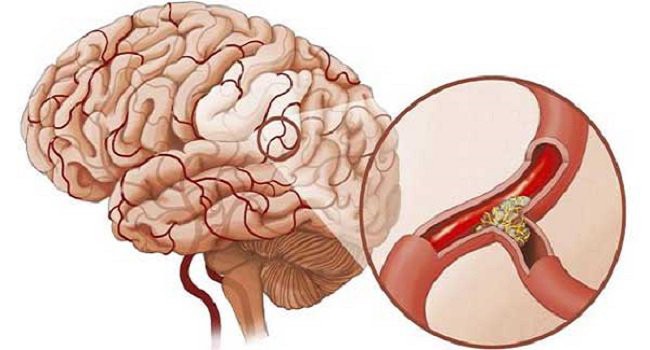 Cô gái 24 tuổi đã bị nhồi máu não vì thường xuyên làm điều này sau quan hệ tình dục - Ảnh 1.