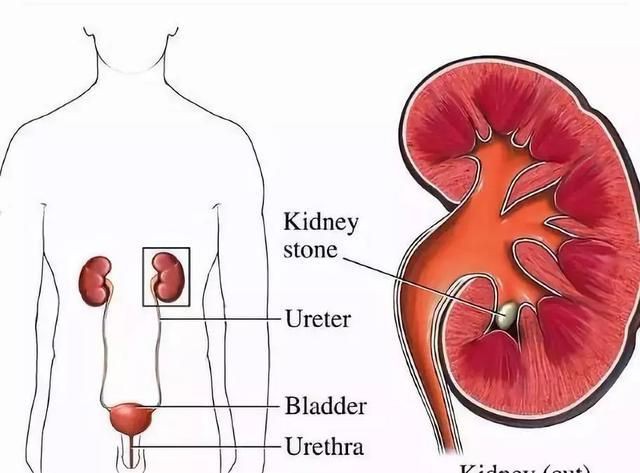 Phải cắt bỏ thận trái khi mới 28 tuổi, bà mẹ trẻ ân hận vì 1 sai lầm trong ăn uống nhiều người cùng mắc - Ảnh 2. Phải cắt bỏ thận trái khi mới 28 tuổi, bà mẹ trẻ ân hận vì 1 sai lầm trong ăn uống nhiều người cùng mắc - Ảnh 2.