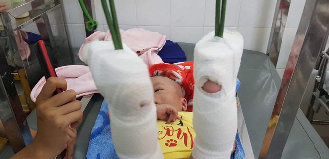 B&eacute; trai 4 th&aacute;ng tuổi nghi bị cha đ&aacute;nh xuất huyết n&atilde;o - Ảnh 1.