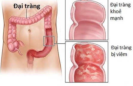 phòng ngừa ung thư phòng ngừa ung thư