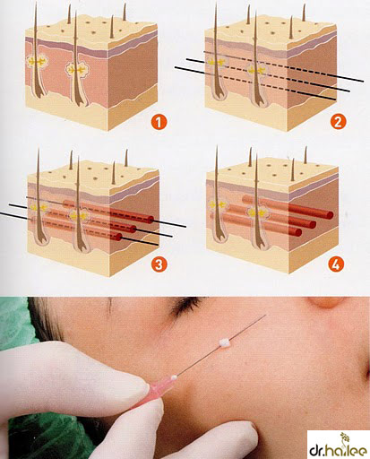 Tất tần tật về công nghệ căng da mặt, nâng cơ bằng... Chỉ 3