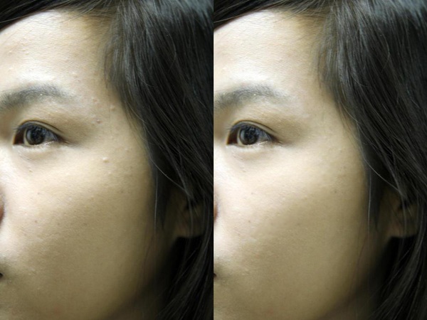 Gel trị mụn Pure skin Spot treatment 10 Gel trị mụn Pure skin Spot treatment 10