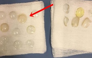 Thấy ngứa mắt, cụ bà 67 tuổi đi khám bác sĩ và tá hỏa phát hiện những thứ này trong mắt
