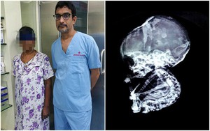 15 năm sau khi phá thai, bà mẹ sốc nặng khi phát hiện con vẫn còn trong bụng 15 năm sau khi phá thai, bà mẹ sốc nặng khi phát hiện con vẫn còn trong bụng
