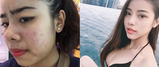 "Đập mặt làm lại" để bước qua quá khứ cay đắng, cô gái Cần Thơ thành hotgirl, đổi đời nhờ thẩm mỹ