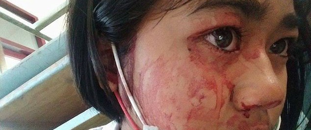Mắc bệnh lạ chục triệu người mới có một, bé gái "đổ mồ hôi" ra máu bất kỳ lúc nào