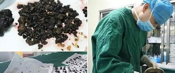 Những thứ được lấy ra từ bụng bệnh nhân khiến bác sĩ không tin nổi, số 1 quá đáng sợ