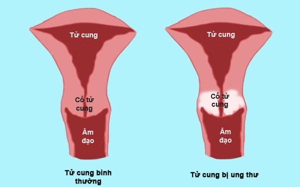 Đừng coi thường những dấu hiệu ung thư cổ tử cung