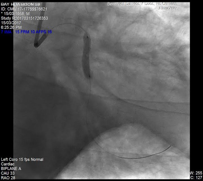TP.HCM: Một bệnh nhân Singapore gần ngưng tim được “hồi sinh” thần kỳ từ cõi chết - Ảnh 1.