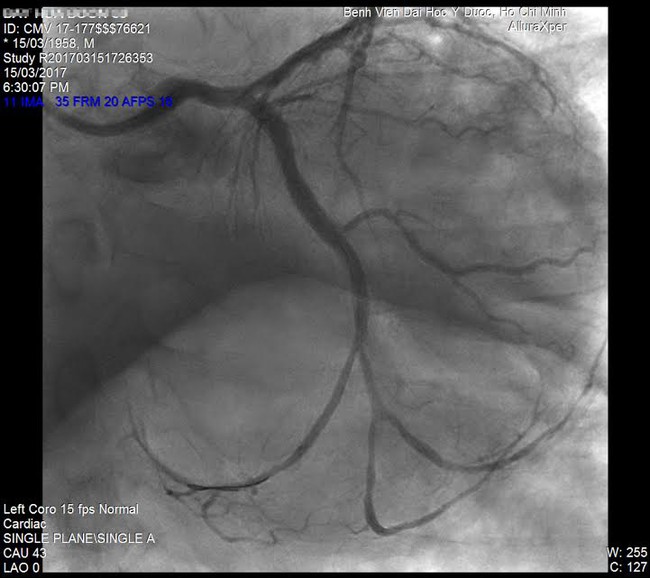 TP.HCM: Một bệnh nhân Singapore gần ngưng tim được “hồi sinh” thần kỳ từ cõi chết - Ảnh 3.
