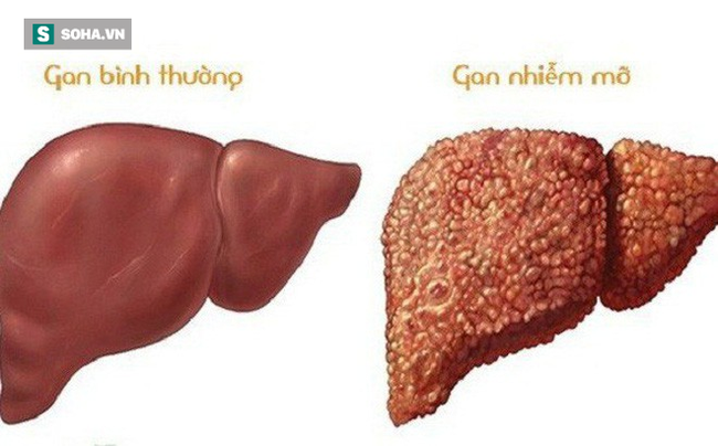 Gan nhiễm mỡ l&agrave; bước đệm dẫn đến xơ gan v&agrave; ung thư: 6 nguy cơ ai cũng cần biết để ph&ograve;ng - Ảnh 1.