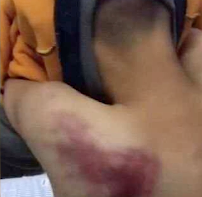 Đi trễ 2 ph&uacute;t, cậu b&eacute; bi gi&aacute;o vi&ecirc;n đ&aacute;nh bằng 4 c&acirc;y chổi, nh&igrave;n ảnh thương t&iacute;ch cư d&acirc;n mạng tức giận: Gi&aacute;o vi&ecirc;n kh&ocirc;ng phải con người - Ảnh 4.