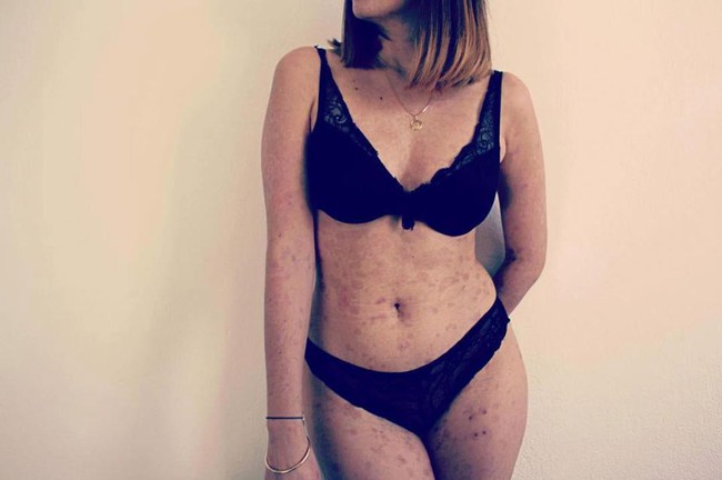 Chỉ v&igrave; d&ugrave;ng loại thuốc n&agrave;y chữa vi&ecirc;m amidan, người phụ nữ đ&atilde; bị bỏng to&agrave;n th&acirc;n  - Ảnh 4.