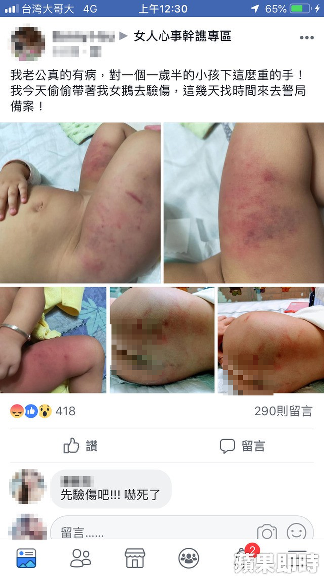 Đài Loan: Dân mạng sục sôi truy tìm danh tính bé gái 1 tuổi nghi bị bố bạo hành đến bầm tím cơ thể - Ảnh 1.