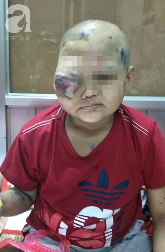 Mắt bất ngờ sưng to, bé trai mang bệnh ung thư: Cảnh báo căn bệnh 80% người mắc bị tái phát sau điều trị - Ảnh 2.