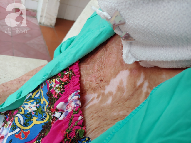 Thương t&acirc;m mẹ trẻ bị lửa xăng đốt n&aacute;t da thịt, một m&igrave;nh chống chọi đau đớn trong viện: &ldquo;Giờ t&ocirc;i chỉ sống v&igrave; con&rdquo; - Ảnh 6.