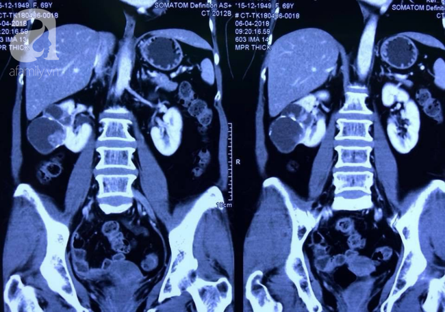 BV c&oacute; Trung t&acirc;m Phẫu thuật nội soi xuất sắc đầu ti&ecirc;n tại VN: Cứu người phụ nữ bị ung thư bằng nội soi 3D - Ảnh 2.
