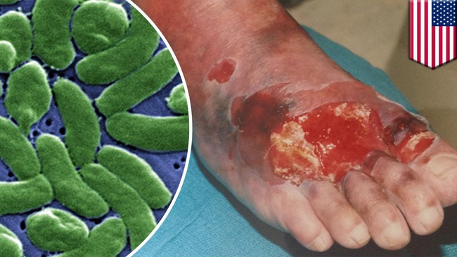 Bị cắt cụt tay chỉ v&igrave; ăn m&oacute;n kho&aacute;i khẩu n&agrave;y: Chuy&ecirc;n gia cảnh b&aacute;o một th&oacute;i quen ăn uống dễ dẫn đến c&aacute;i kết đắng! - Ảnh 4.