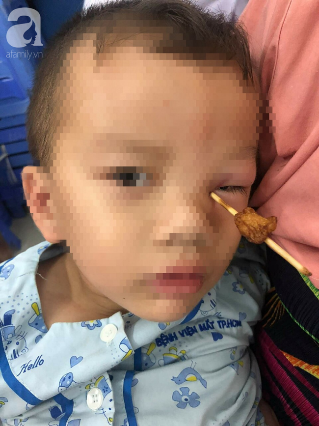 Vấp ng&atilde; khi chạy phụ cha đẩy xe, b&eacute; trai 4 tuổi bị xi&ecirc;n c&aacute; vi&ecirc;n đ&acirc;m s&acirc;u v&agrave;o hốc mắt - Ảnh 1.