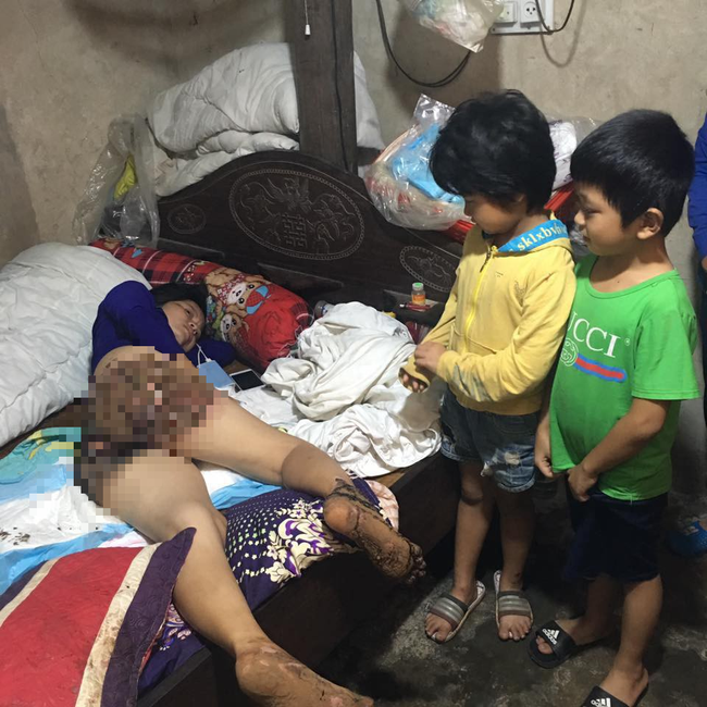 Bị bỏng nặng, da thịt thối rữa, người phụ nữ bị t&ecirc; liệt ch&acirc;n tay vẫn phải cắn răng chịu đựng v&igrave; kh&ocirc;ng đủ tiền nhập viện - Ảnh 2.