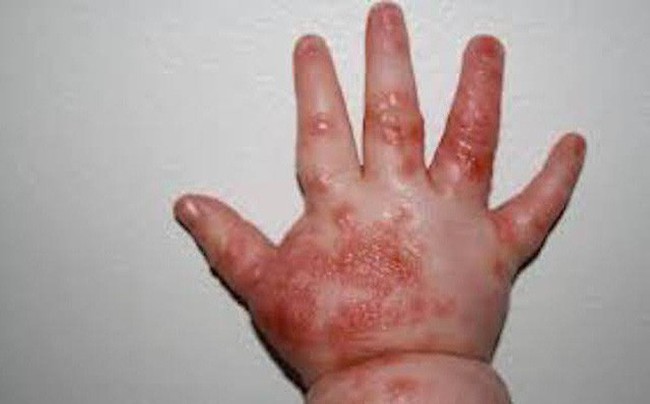 B&eacute; g&aacute;i 2 tuổi tử vong do bệnh tay ch&acirc;n miệng ở Bến Tre - Ảnh 1.