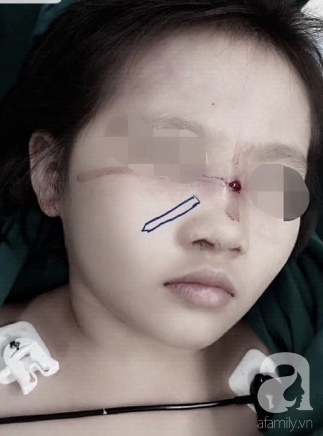 Tai nạn kinh hoàng cận Tết: Cầm bút chì chơi rồi vấp ngã, bé gái 6 tuổi bị đâm xuyên từ mũi đến hốc mắt - Ảnh 1.