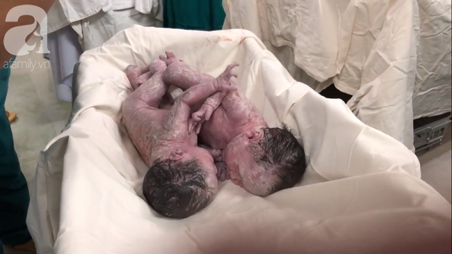 Hai b&eacute; g&aacute;i song sinh d&iacute;nh nhau đ&atilde; xuất viện: B&aacute;c sĩ kể lại gi&acirc;y ph&uacute;t đưa con ra khỏi bụng mẹ - Ảnh 1.