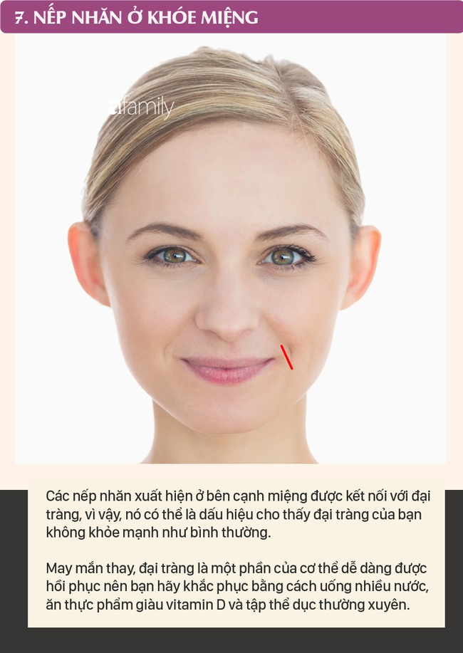 Mỗi nếp nhăn trên khuôn mặt gửi một thông điệp về sức khỏe, dưới đây là 10 vị trí nếp nhăn bạn cần nhận ra - Ảnh 7.
