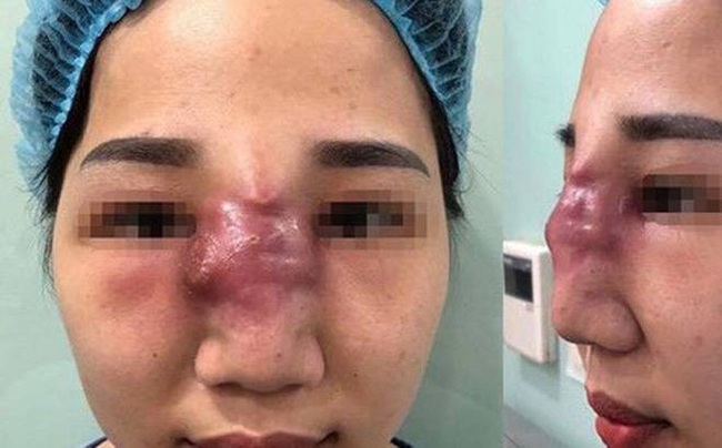 Gần Tết hãy cảnh giác với tiêm filler làm đẹp: Chuyên gia cảnh báo không phải ai cũng có thể tiêm filler! - Ảnh 1.