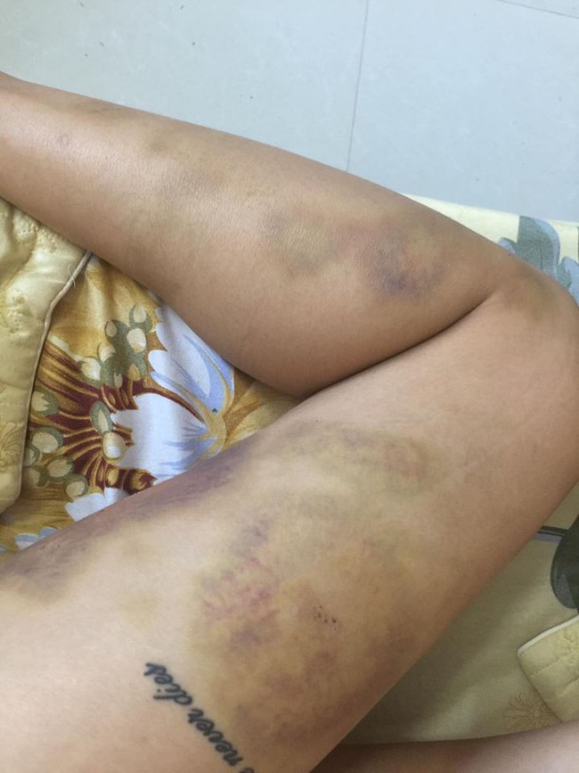 Ca lụy t&igrave;nh khiến MXH s&ocirc;i m&aacute;u: C&ocirc; g&aacute;i vẫn tha thứ mặc bạn trai nhiều lần bạo h&agrave;nh, tay ch&acirc;n bầm dập, v&agrave;o viện như cơm bữa - Ảnh 3.