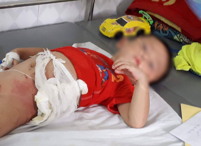 H&ograve;a B&igrave;nh: Cậu ruột n&eacute;m ch&aacute;u trai 4 tuổi v&agrave;o đống lửa v&igrave; gi&agrave;nh ăn quả dưa chuột - Ảnh 1.