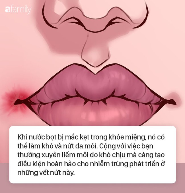 8 dấu hiệu ở môi cứ xuất hiện là cảnh báo bệnh, bạn cần đi khám sớm là tốt nhất  - Ảnh 1.