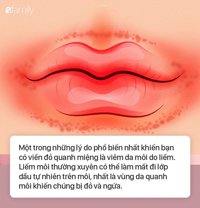 8 dấu hiệu ở môi cứ xuất hiện là cảnh báo bệnh, bạn cần đi khám sớm là tốt nhất  - Ảnh 4.