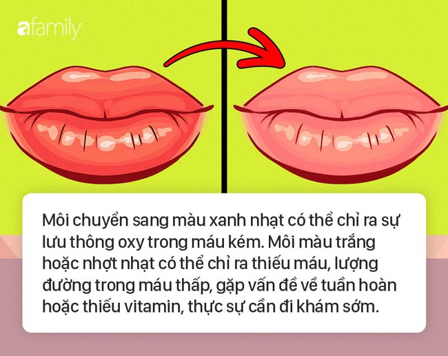 8 dấu hiệu ở môi cứ xuất hiện là cảnh báo bệnh, bạn cần đi khám sớm là tốt nhất  - Ảnh 6.