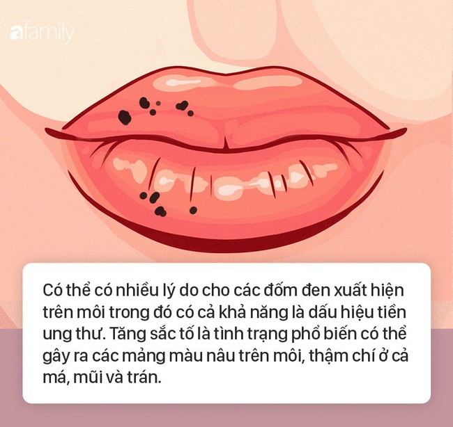 8 dấu hiệu ở môi cứ xuất hiện là cảnh báo bệnh, bạn cần đi khám sớm là tốt nhất  - Ảnh 8.