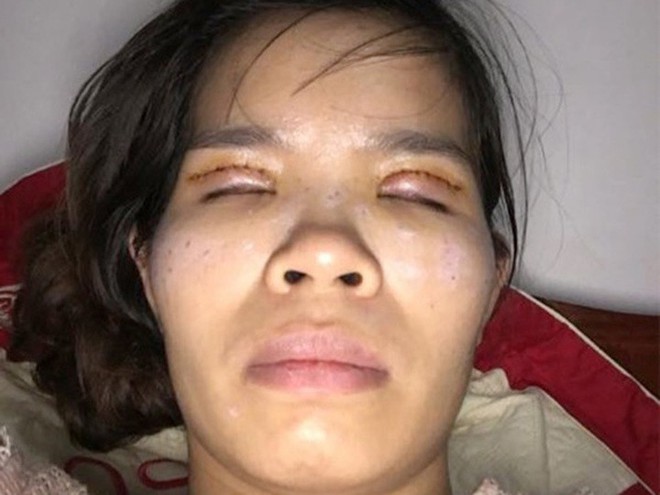 Là tiểu phẫu nhưng cắt mí hay bóc mỡ bọng mắt cũng có thể gây ra những hậu quả nhìn kinh khủng như thế này - Ảnh 10. Là tiểu phẫu nhưng cắt mí hay bóc mỡ bọng mắt cũng có thể gây ra những hậu quả nhìn kinh khủng như thế này - Ảnh 10.