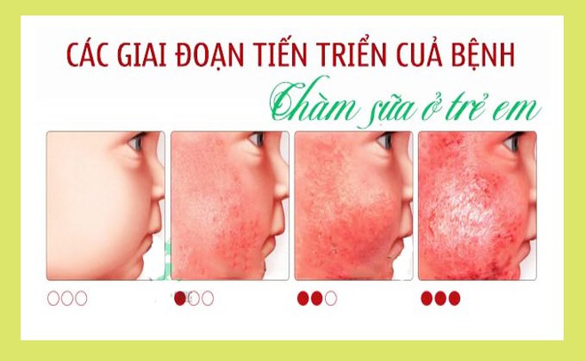 Những tưởng con mắc 4 chứng bệnh về da nhưng sau cùng mẹ thở phào vì bé chỉ bị loại mụn nhẹ này thôi - Ảnh 2. Những tưởng con mắc 4 chứng bệnh về da nhưng sau cùng mẹ thở phào vì bé chỉ bị loại mụn nhẹ này thôi - Ảnh 2.