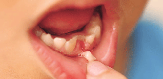 Bác sỹ nha khoa cảnh báo 2 trường hợp bố mẹ không nên tự nhổ răng sữa cho con tại nhà - Ảnh 1.