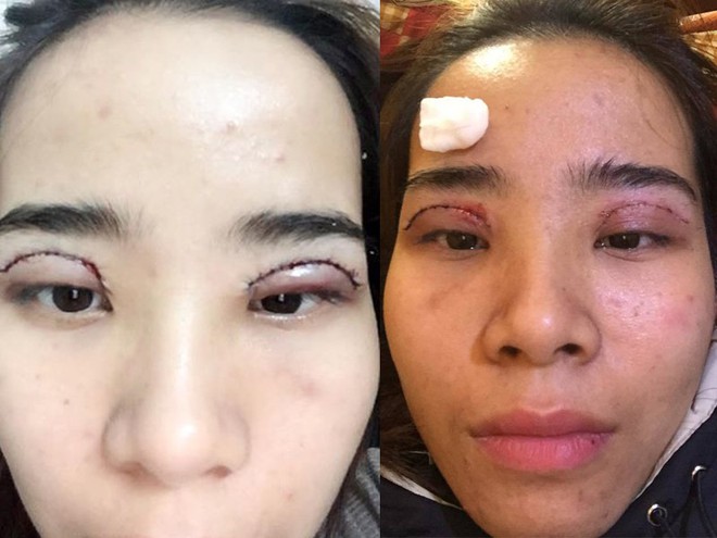 Là tiểu phẫu nhưng cắt mí hay bóc mỡ bọng mắt cũng có thể gây ra những hậu quả nhìn kinh khủng như thế này - Ảnh 8. Là tiểu phẫu nhưng cắt mí hay bóc mỡ bọng mắt cũng có thể gây ra những hậu quả nhìn kinh khủng như thế này - Ảnh 8.