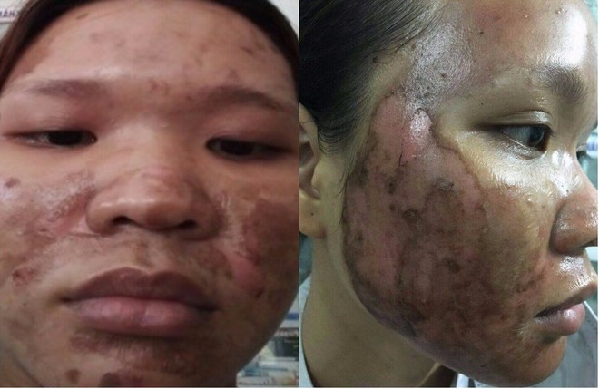 Làm đẹp dại cô nàng xinh đẹp rước hại vào thân: da bỏng hoàn toàn, vướng tin đồn giật chồng nên bị tạt axit - Ảnh 4. Làm đẹp dại cô nàng xinh đẹp rước hại vào thân: da bỏng hoàn toàn, vướng tin đồn giật chồng nên bị tạt axit - Ảnh 4.