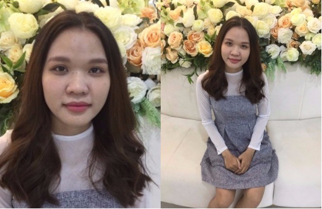 Làm đẹp dại cô nàng xinh đẹp rước hại vào thân: da bỏng hoàn toàn, vướng tin đồn giật chồng nên bị tạt axit - Ảnh 6. Làm đẹp dại cô nàng xinh đẹp rước hại vào thân: da bỏng hoàn toàn, vướng tin đồn giật chồng nên bị tạt axit - Ảnh 6.