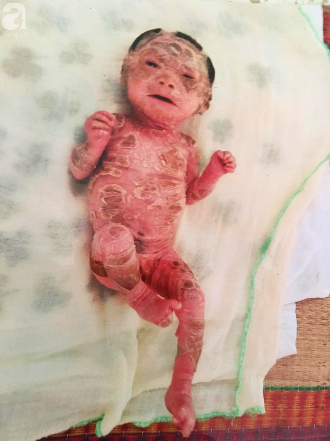 Rớt nước mắt bé gái 14 tháng tuổi người như da trăn, nổi vẩy ngứa bị bố mẹ bỏ rơi mà không có tiền chữa trị - Ảnh 5.