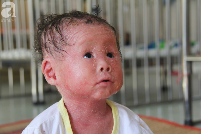 Rớt nước mắt bé gái 14 tháng tuổi người như da trăn, nổi vẩy ngứa bị bố mẹ bỏ rơi mà không có tiền chữa trị - Ảnh 15.