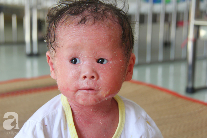 Rớt nước mắt bé gái 14 tháng tuổi người như da trăn, nổi vẩy ngứa bị bố mẹ bỏ rơi mà không có tiền chữa trị - Ảnh 2.