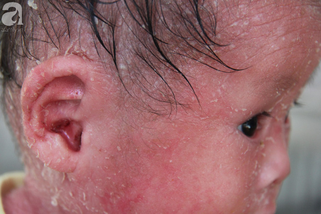 Rớt nước mắt bé gái 14 tháng tuổi người như da trăn, nổi vẩy ngứa bị bố mẹ bỏ rơi mà không có tiền chữa trị - Ảnh 4.