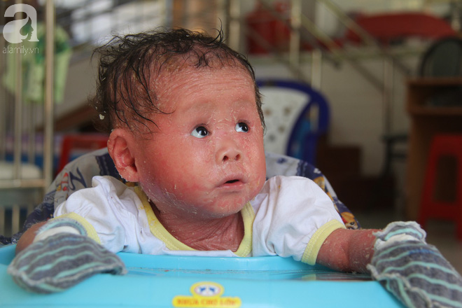 Rớt nước mắt bé gái 14 tháng tuổi người như da trăn, nổi vẩy ngứa bị bố mẹ bỏ rơi mà không có tiền chữa trị - Ảnh 13.
