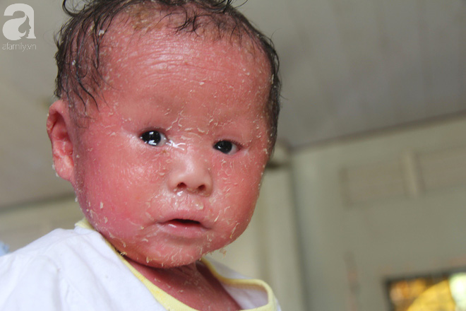 Rớt nước mắt bé gái 14 tháng tuổi người như da trăn, nổi vẩy ngứa bị bố mẹ bỏ rơi mà không có tiền chữa trị - Ảnh 12.