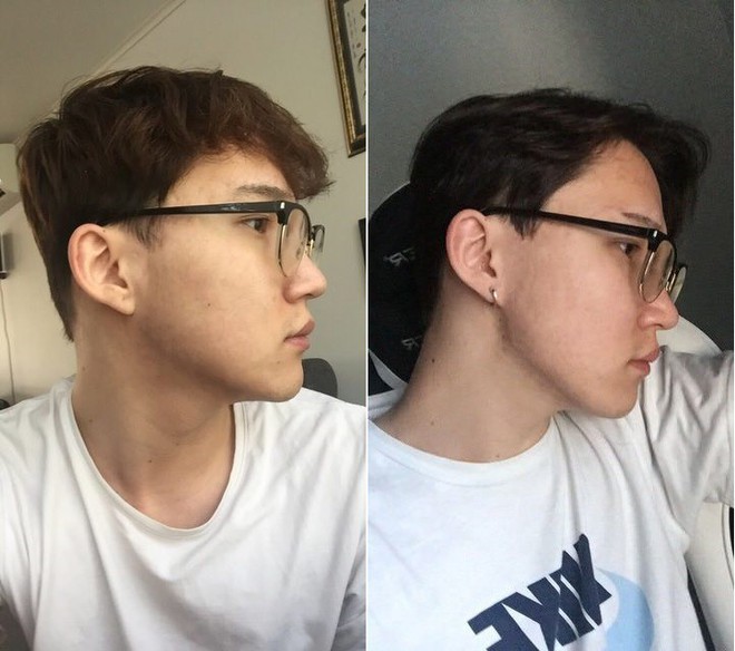 Sau 2 năm khổ vì mụn tấy đỏ, mặt anh chàng này đã thay đổi bất ngờ kể từ khi chuyển sang dưỡng da kiểu Hàn - Ảnh 1.